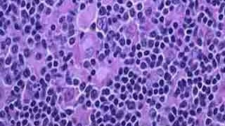 Causes & Treatment of Lymphoma in Hindi Video | लिम्फोमा के कारण और इलाज