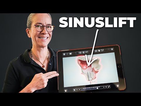 Sinus lift explained in 4 minutes: with animation