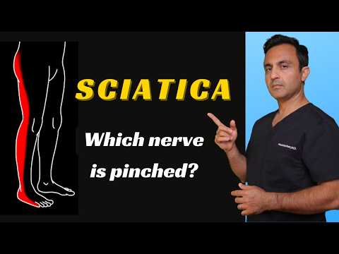 "Which nerve is pinched in my back?"