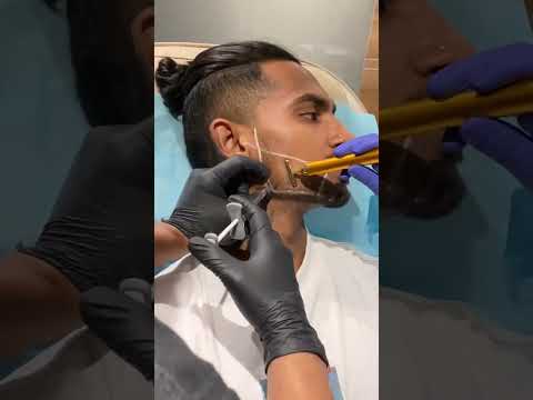 Non-Invasive Face Transformation in Ahmedabad, India | Jawline and Chin Augmentation