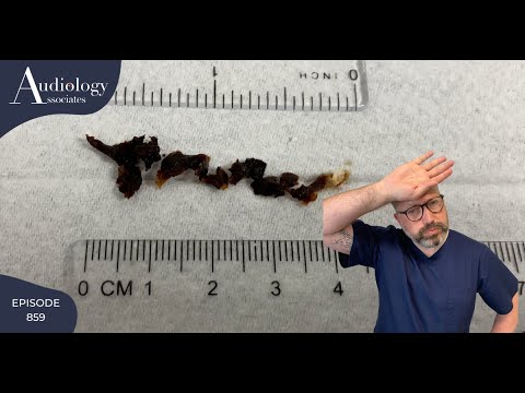 HARD EAR WAX REMOVALFROM A NARROW EAR CANAL - EP859