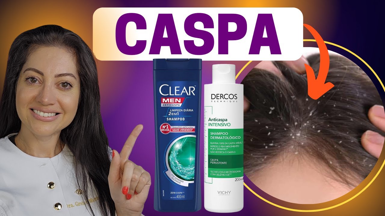 Livre-se da Caspa: Tratamentos e Cuidados Essenciais para um Couro Cabeludo Saudável | Dra. Greice