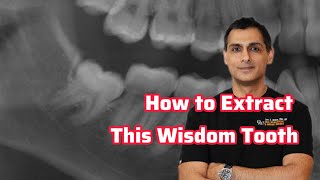 Lower Wisdom Tooth Removal Dr. Wahan