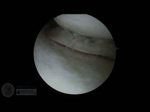 Complex Medial Meniscus Tear: vertical/bucket handle and deep horizontal cleavage components