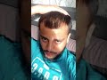2 Year Hair Loss Transformation Baldcafe