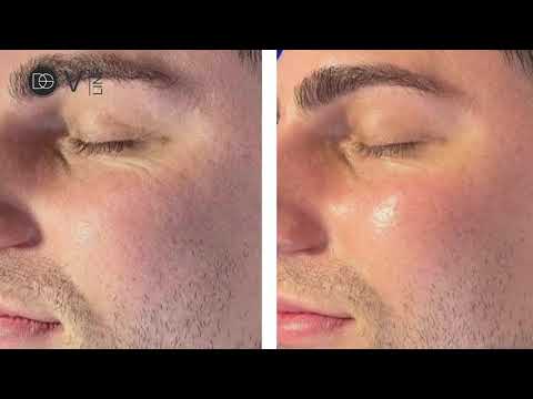 DS V-Line AI Fili di Collagene: Il rivoluzionario trattamento non invasivo per eliminare le rughe