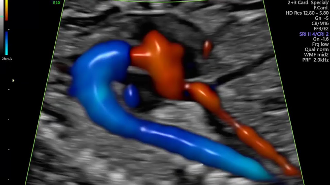 ECOCARDIOGRAFIA FETAL COM FLUXO EM CORES