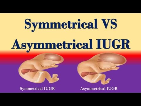 Symmetrical and Asymmetrical IUGR Differences : Symmetrical Vs Asymmetrical IUGR