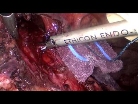 Abordaje de la acalasia en etapa terminal con desnutrición severa