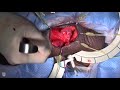 Mayo Clinic Men S Health Moment Penile Implant Abridged Operative Video