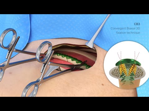 L1® Rib | Patient Education