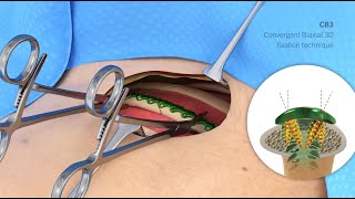 L1® Rib | Patient Education