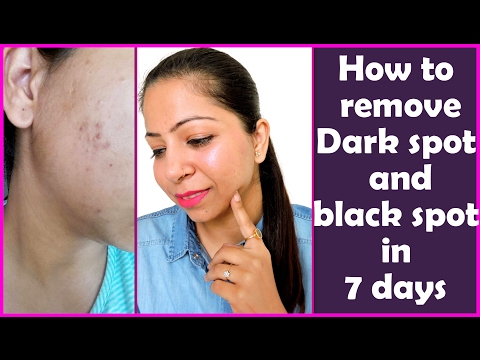 How to Remove Dark Spots & Black Spots on Face at Home in 7 days | Get Rid of Dark Spots on Face