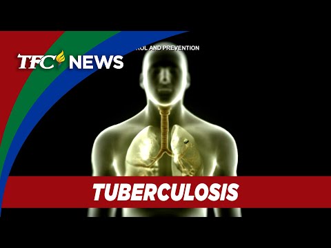 Report finds Filipinos most affected by tuberculosis in Santa Clara county TFC News California
