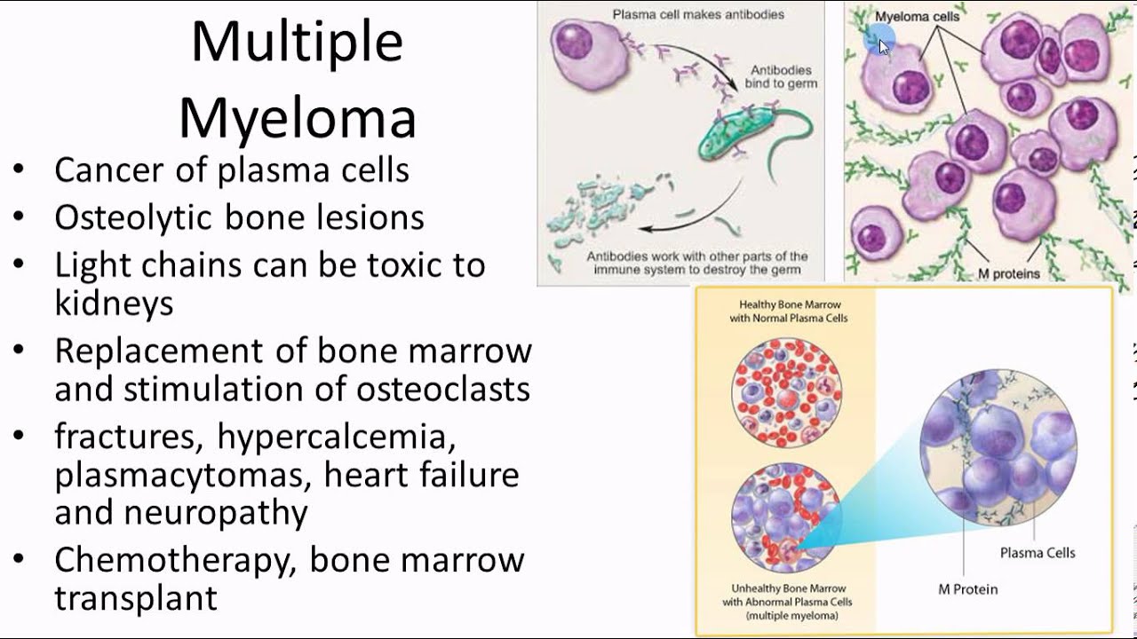 Pathophysiology cardiovasular 5b of 5 leukemias - YouTube