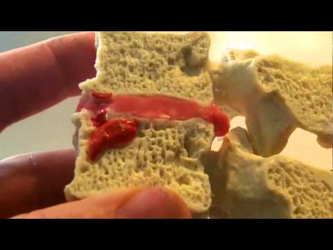 Endplate Thickening and Woven Bone by Dynamic Disc Designs Corp.