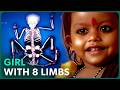 The Girl Born With 8 Limbs Hindu Goddess Or Normal Little Girl