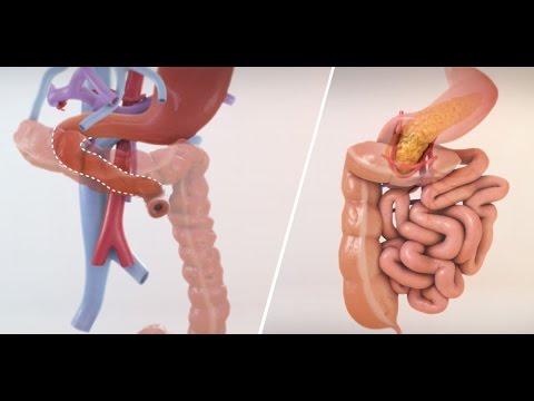 What Is an Intestine Transplant