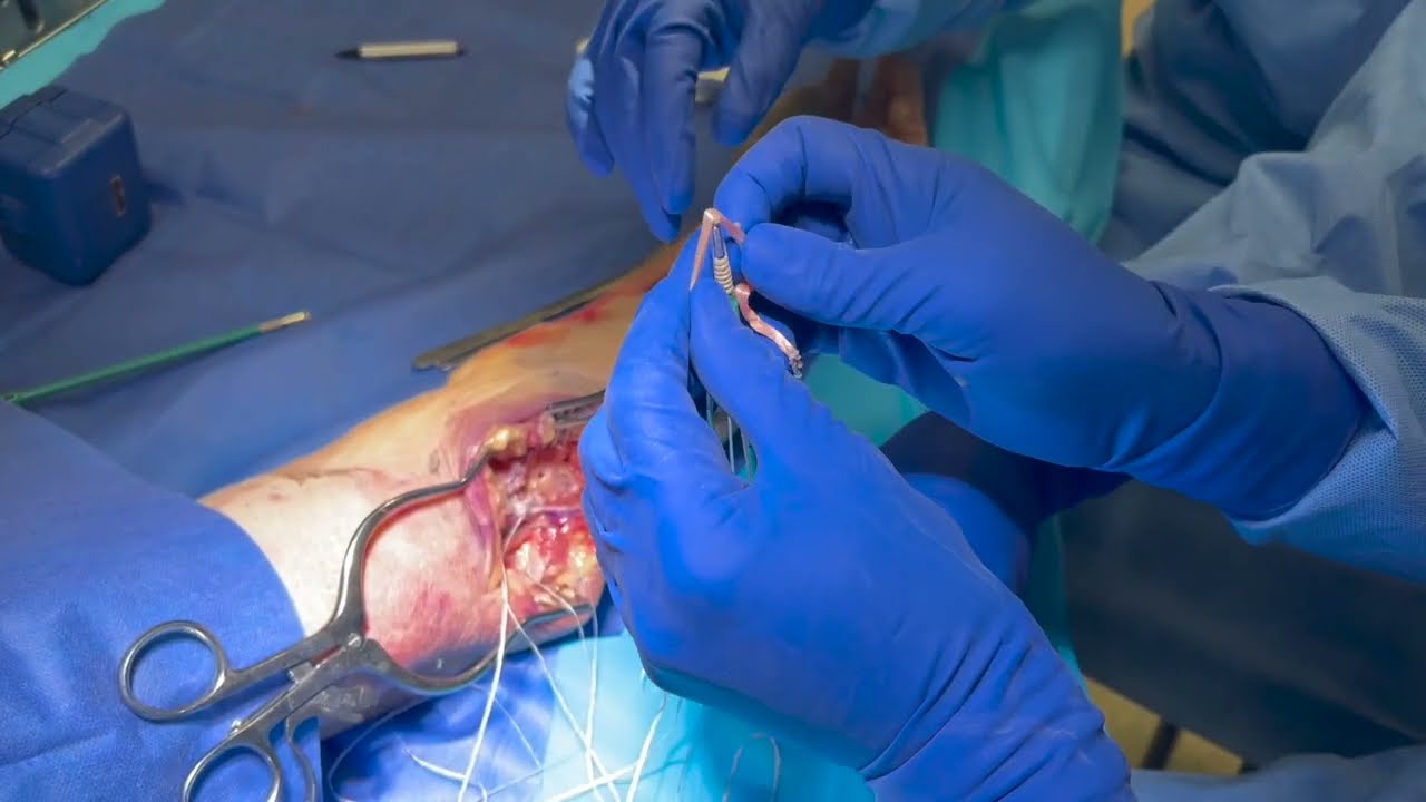 Dr. Garcia’s new technique for elbow UCL reconstruction