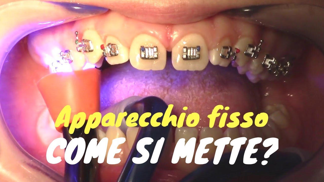 Watch Now Come si mette l'apparecchio fisso Come si mette l'apparecchio fisso