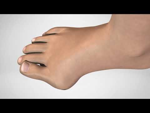 miniBunion Patient website Animation