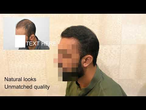 Body Fue  Plus PRP Hair Transplant, Natural Growing Hairs