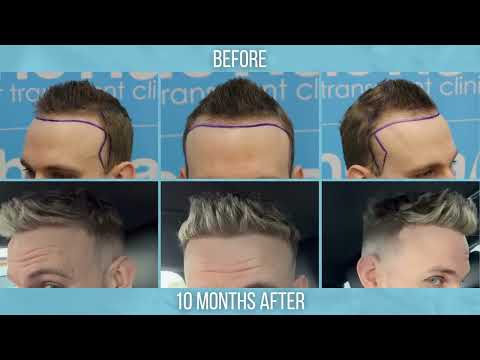 Blonde Hair FUE Hair Transplant by Dr Arshad (Patient...