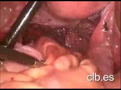 Resección anterior del recto - Centro Laparoscópico Dr. Ballesta