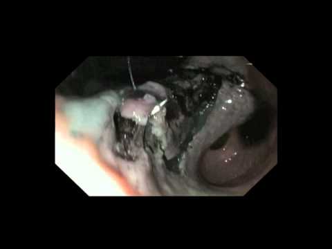 Incisionless Gastric Cancer Resection Using Endoscopic Suturing with Pulley Retraction