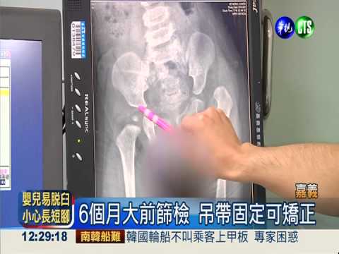 新生兒髖關節脫臼 易生長短腳