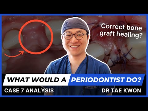 What Would a Periodontist Do? With Dr Tae Kwon - Case 7