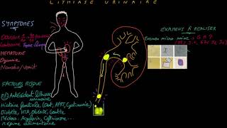 Lithiase urinaire - Docteur Synapse