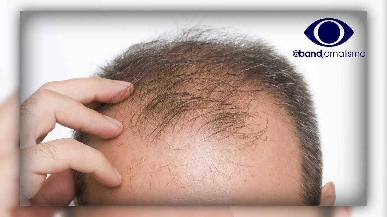 Estudo aponta tratamento mais eficaz contra a calvície