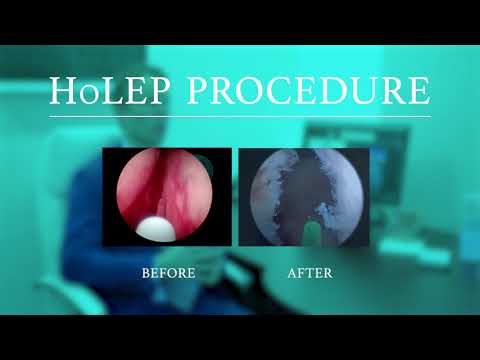 Holmium Laser Enucleation of the Prostate (HoLEP)