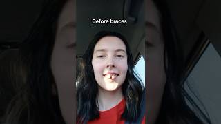 Crazy dental transformation with braces