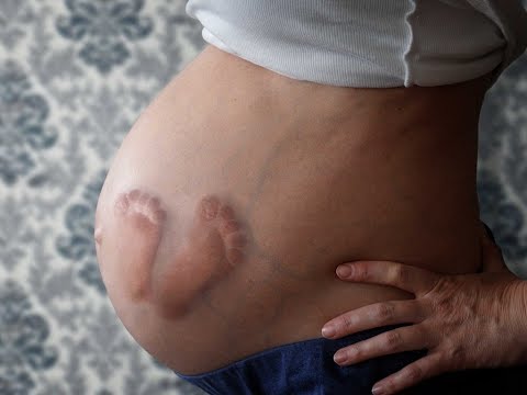 La femme avec 2 vagins et 2 utérus a enfin donné naissance à son bébé malgré tout pronostic médical Video