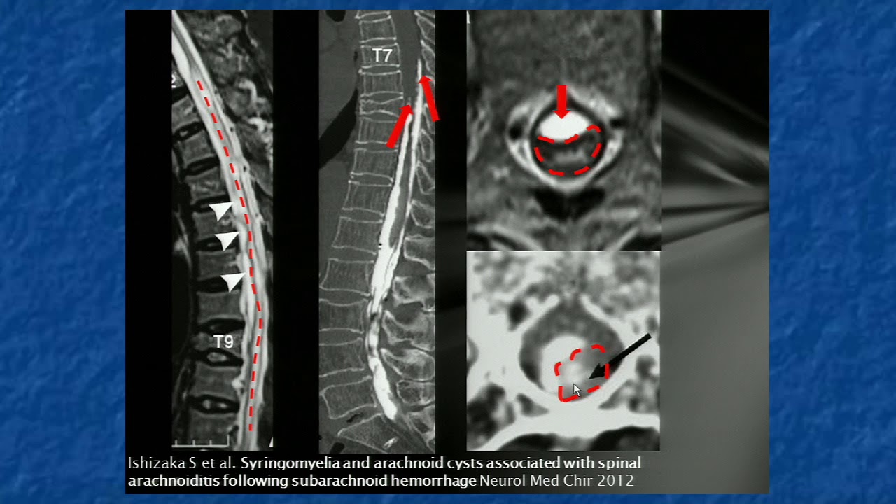 09 Patologie infiammatorie del midollo spinale. Alessandro Stecco