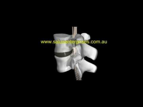 Tabletten von Osteochondrose Foto Warum verletzt die Ellenbogengelenke