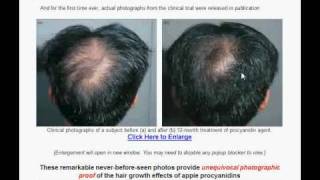 Hair Loss Treatment Men Video
