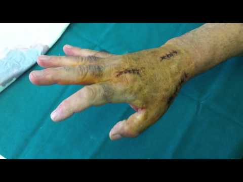 Alterazioni degenerative-distrofici nel cervicale e toracico Malattie articolari e loro trattamento.