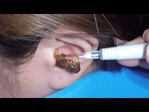 The Most Massive Earwax Removed in One Scoop