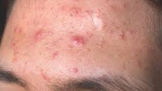 How to remove pimples fast at home/Home remedies for pimple