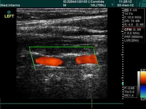 Arterias vertebrales en el examen Doppler