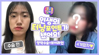 [양악수술 브이로그] 안면비대칭+부정교합+주걱턱+긴얼굴 웬만한 건 다 있었어요 ㅠㅠ