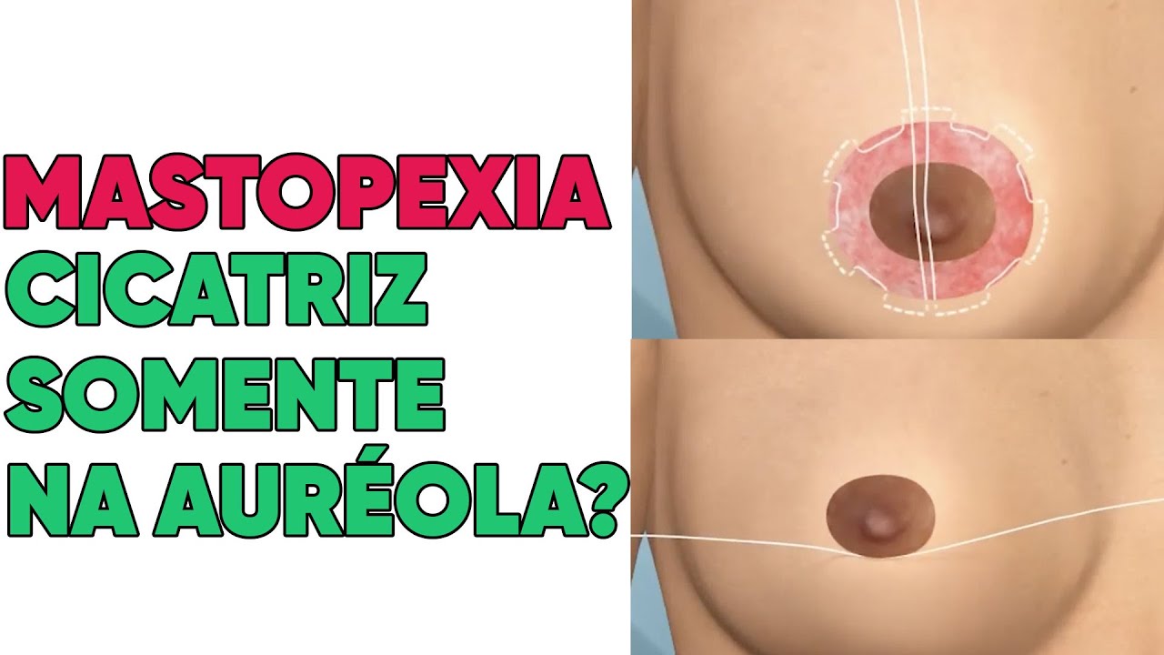 CICATRIZ DA MASTOPEXIA NOVA TÉCNICA