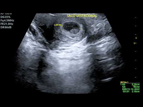 6 SEMANAS DE GESTACIÓN Y NO SE PERCIBE FRECUENCIA CARDÍACA FETAL QUE HACER?