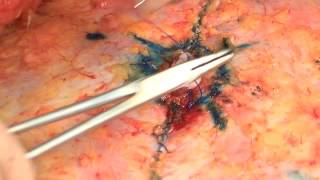 Belly Button Beauty: Dr. Patronella's Detailed Approach to Restoring Beauty to The Navel