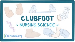 Clubfoot: Clinical Nursing Care