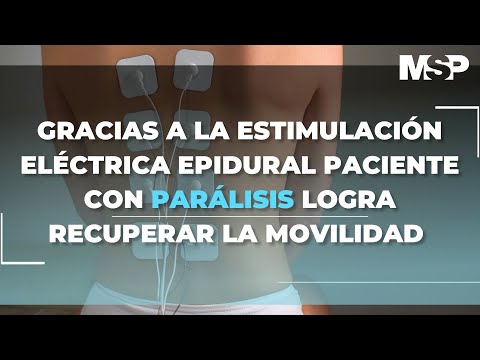 Estimulación Eléctrica Epidural en beneficio de los pacientes - #ExclusivoMSP