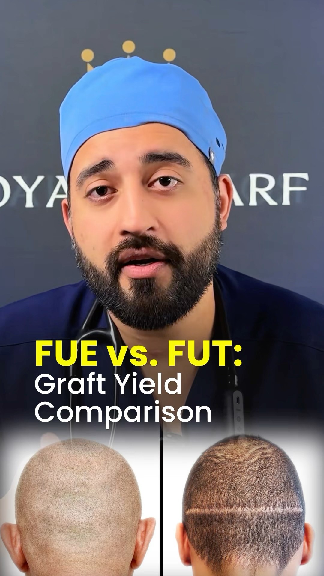 FUE vs FUT Graft Comparison #hairtransplant
